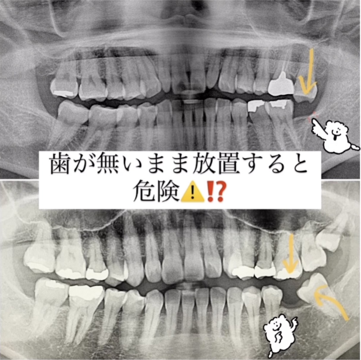 歯が無いまま放置するとどうなってしまうの？！