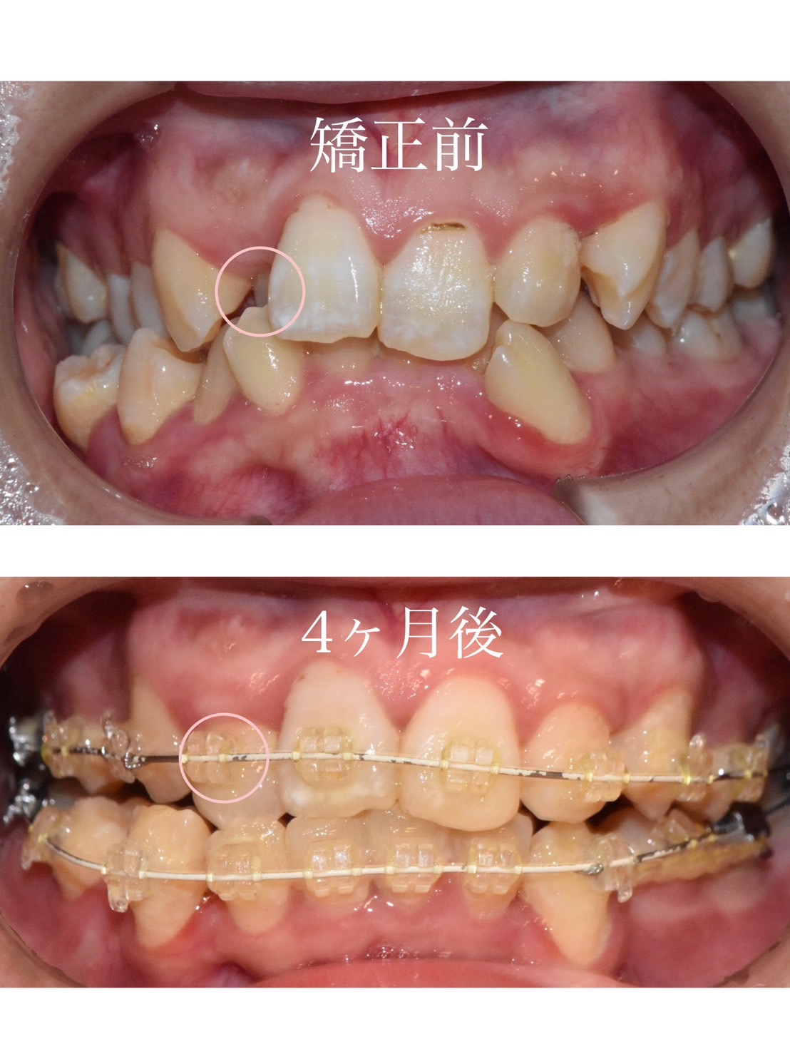 矯正治療の経過🦷