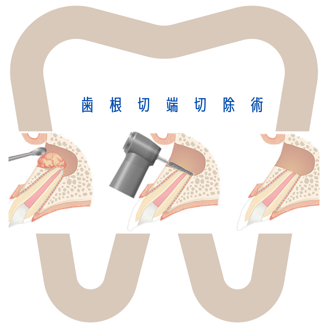 歯根切端切除術