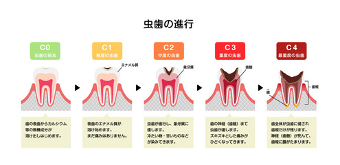 虫歯進行具合