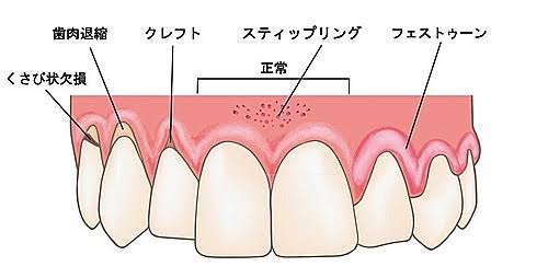 歯磨きの力加減