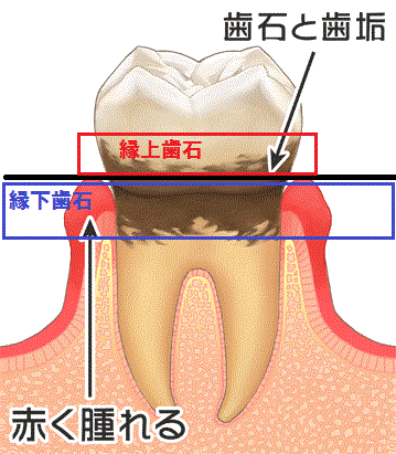 歯石の種類🦷