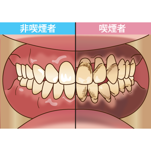 喫煙と歯周病