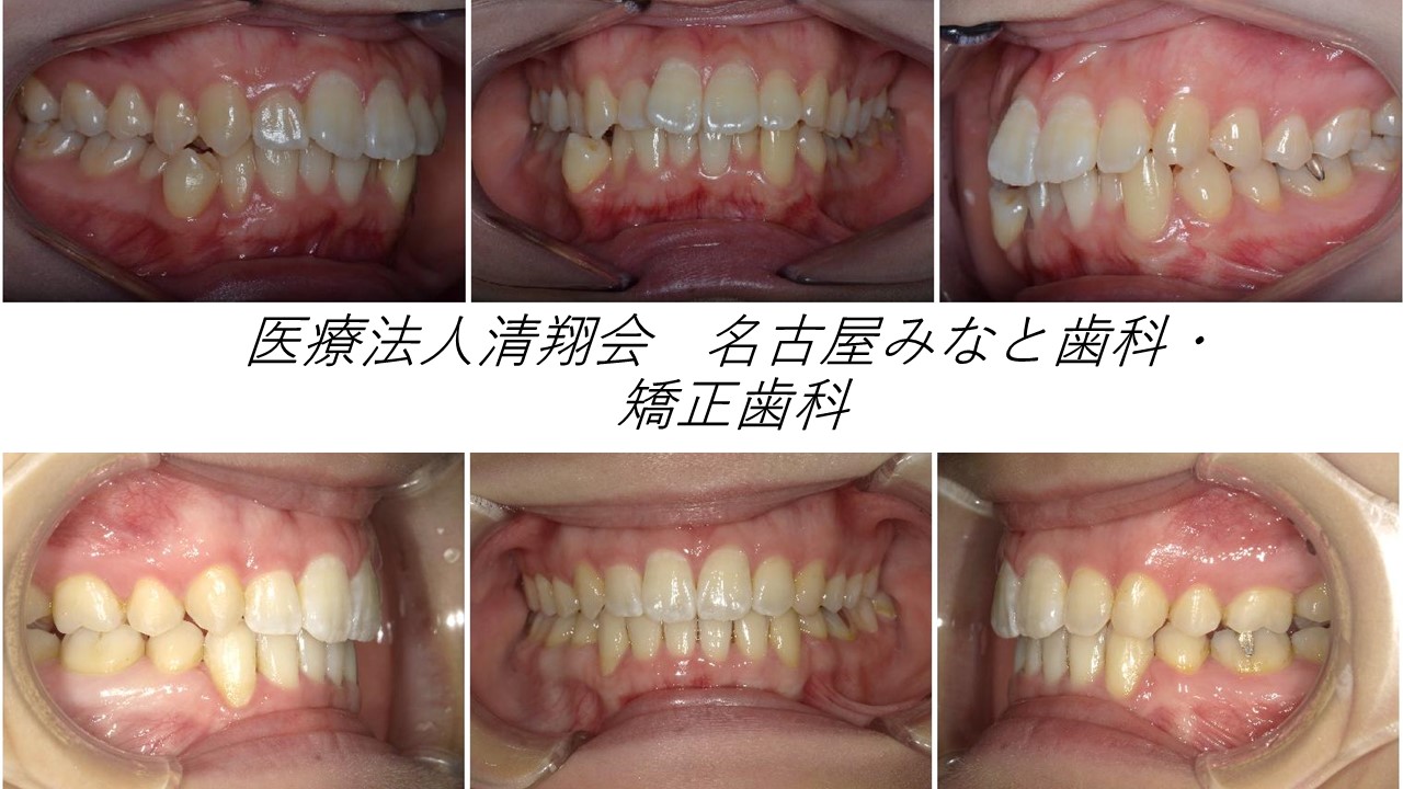 インビザライン矯正患者様のご紹介