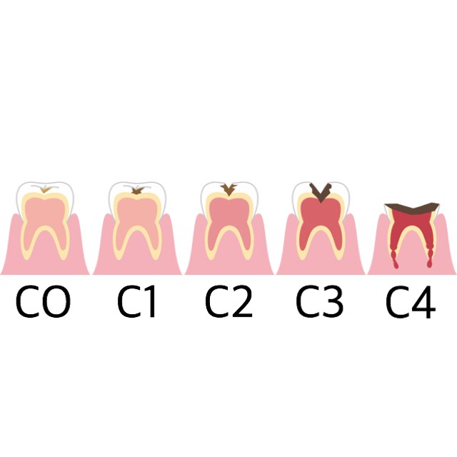 虫歯の進み方