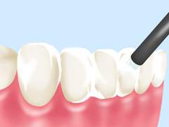 虫歯に負けない強い歯を作るフッ素塗布