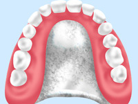 違和感が少なく食事が楽しめる～金属床義歯～