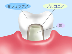 ジルコニアクラウン