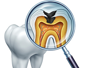 重度の虫歯の治療方法～根管治療～