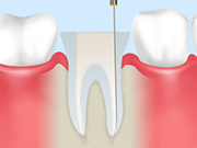 根管治療の流れ