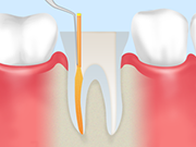 根管治療の流れ