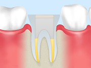根管治療の流れ