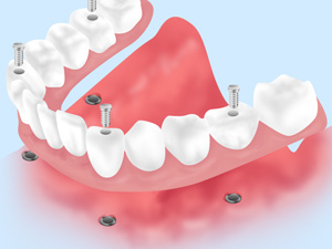 多くの歯を失った方のための「All-on-4（オールオンフォー）」