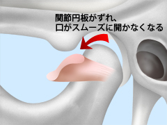 顎関節症とは