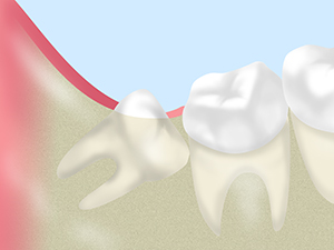 親知らずの抜歯（歯科口腔外科）について