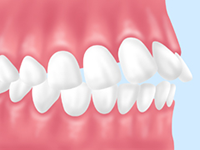 上顎前突（じょうがくぜんとつ）「出っ歯」