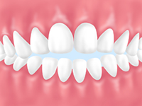 開咬（かいこう）「上下の前歯が閉じない」
