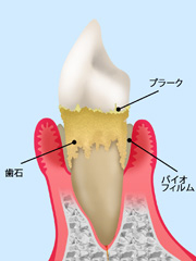 歯周病とは