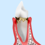 歯肉炎・軽度歯周炎