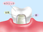 メタルボンド