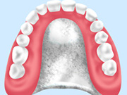 金属床義歯（片顎）